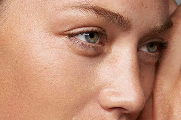 Blepharoplasty