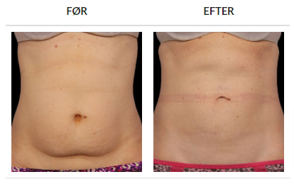 coolsculpting