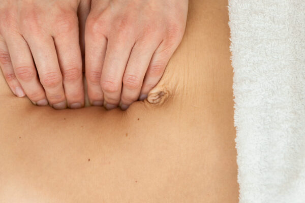 rectus diastase