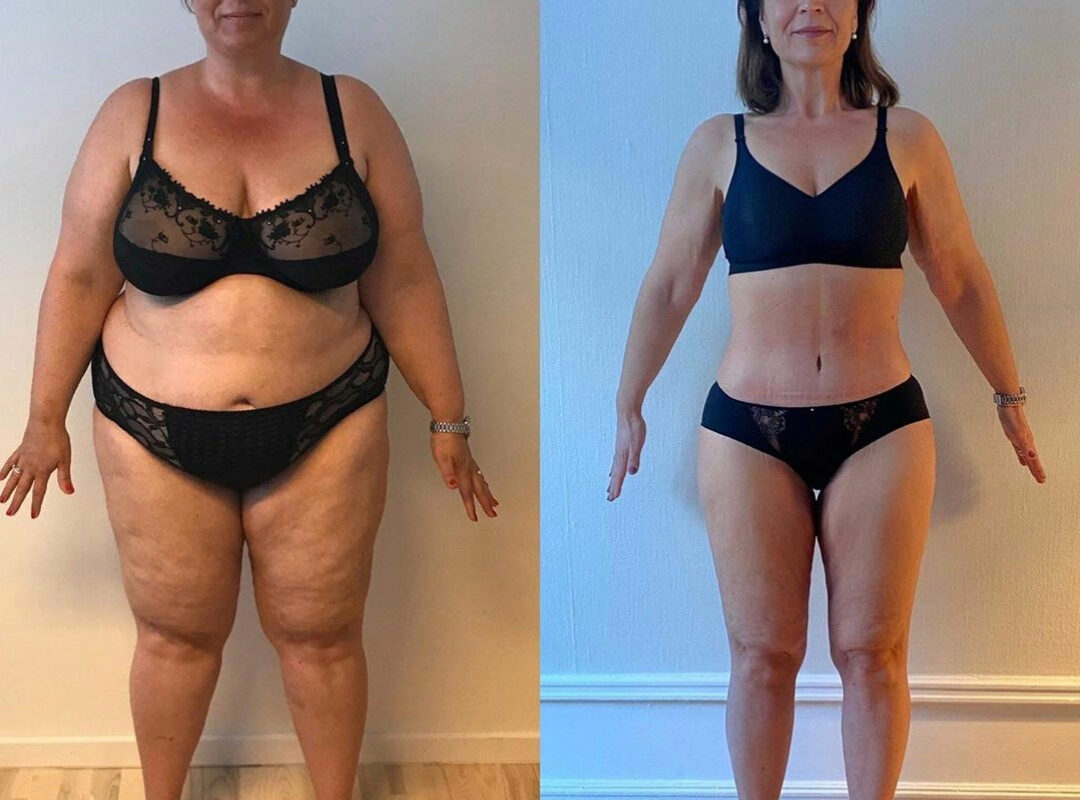 mommy makeover