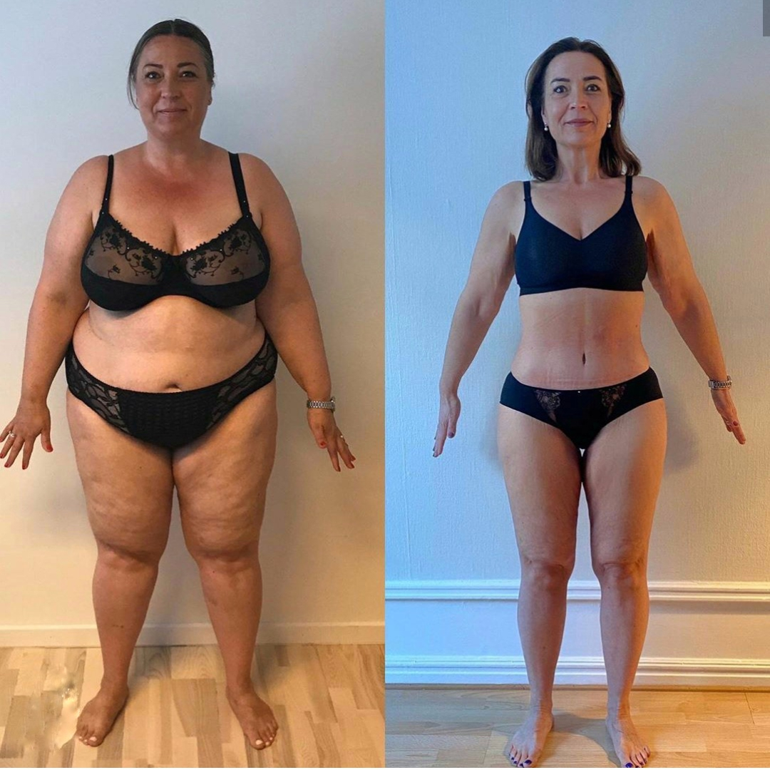 mommy makeover