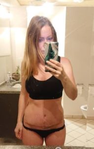 mommy makeover