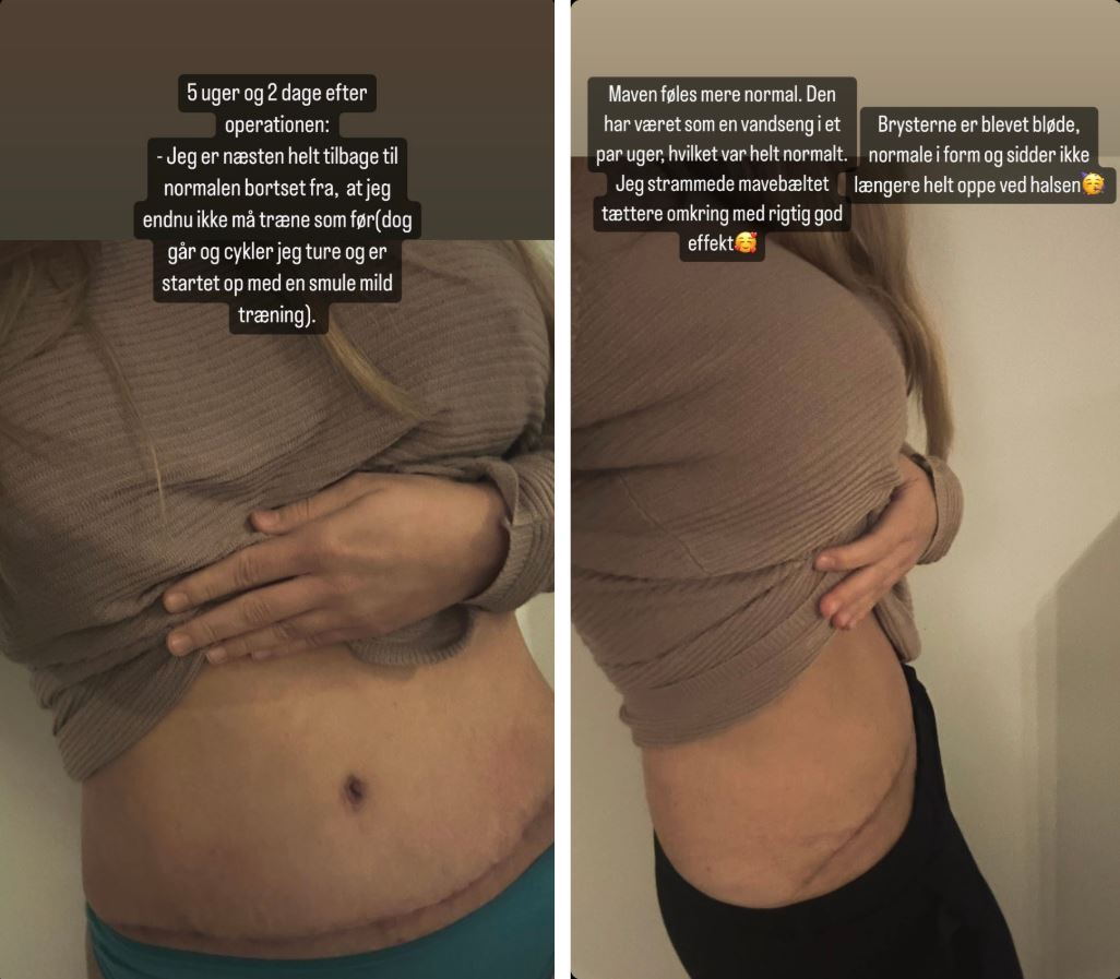 majse mommy makeover