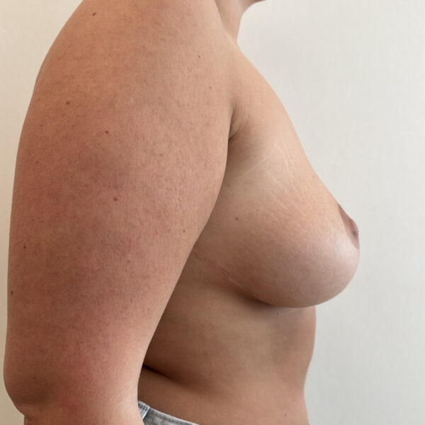 Brystreduktion - Efter