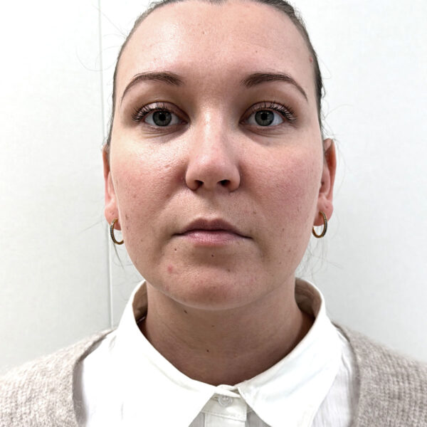 Fedtsugning hals/hage - Efter