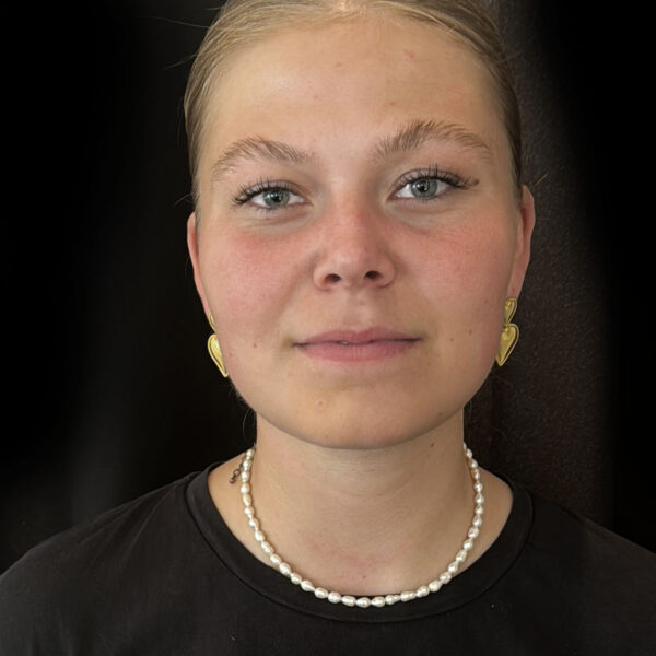 Fedtsugning af øvre del af hals - Efter