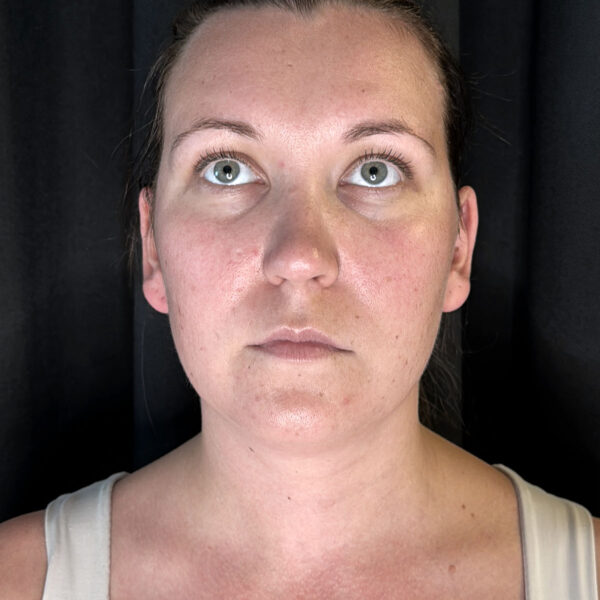 Fedtsugning hals/hage - Før