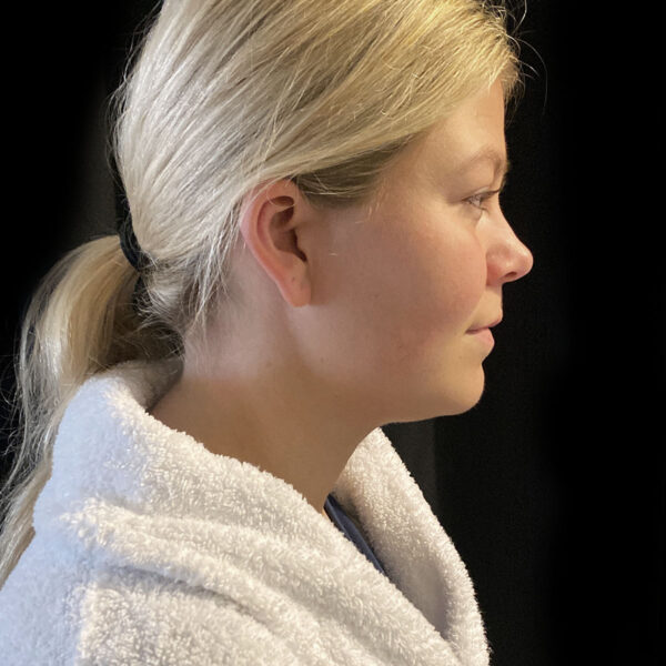 Fedtsugning af øvre del af hals - Før