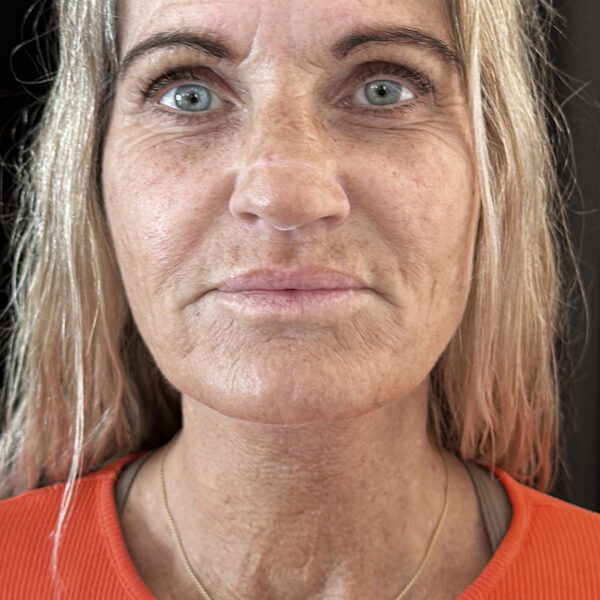Halsløft - Efter