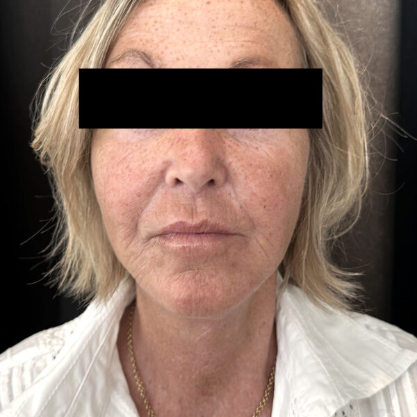 Halsløft - Efter