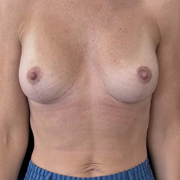 Udskiftning af implantater - Efter