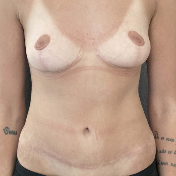 Weightloss - Efter