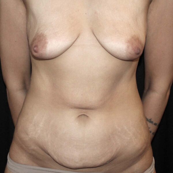 Weightloss - Før