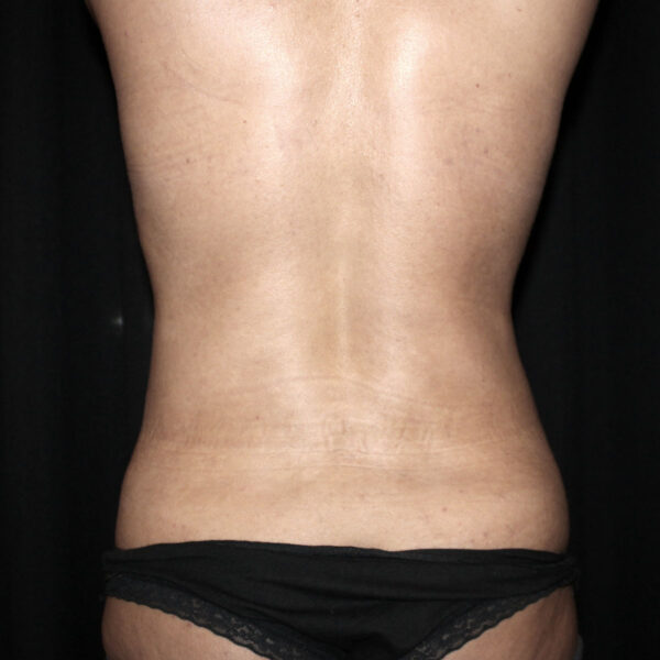 Fedtsugning - Efter