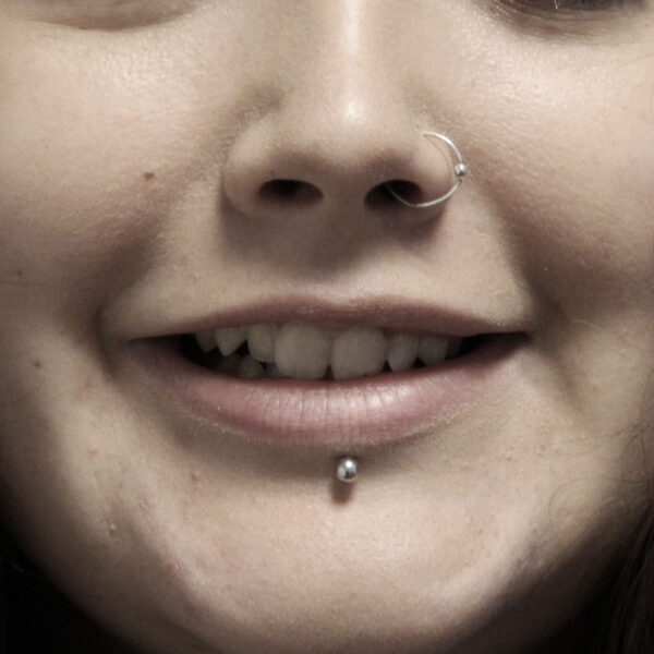 Botox gummy - Efter