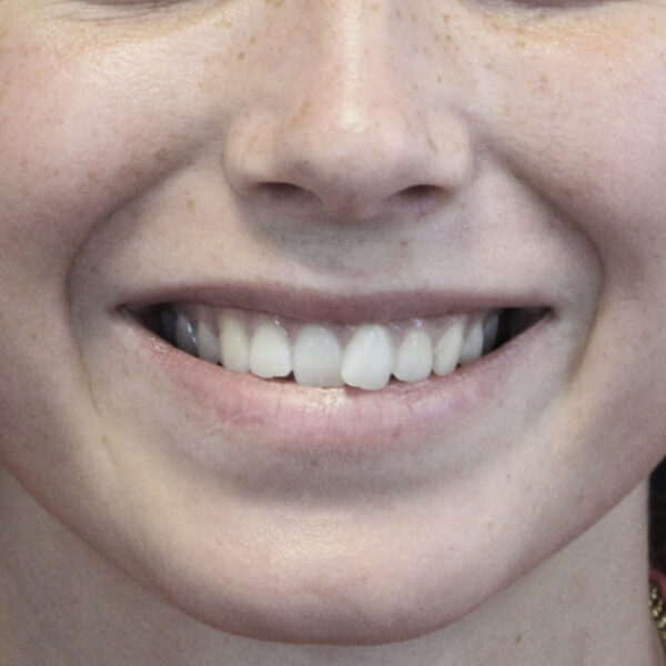 Botox gummy - Efter