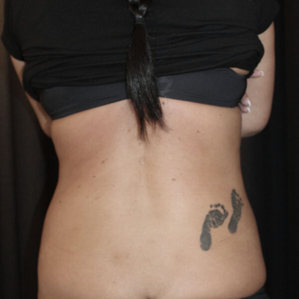 Fedtsugning hofter - Efter