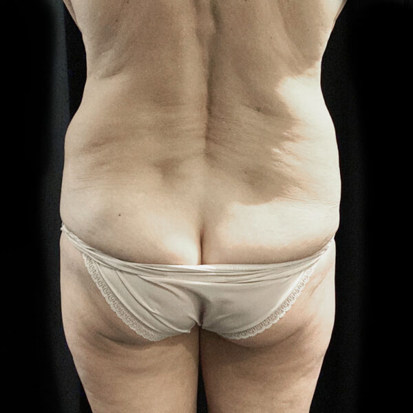 Fedtsugning - Efter