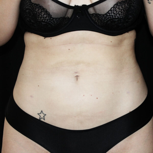 Fedtsugning - Efter
