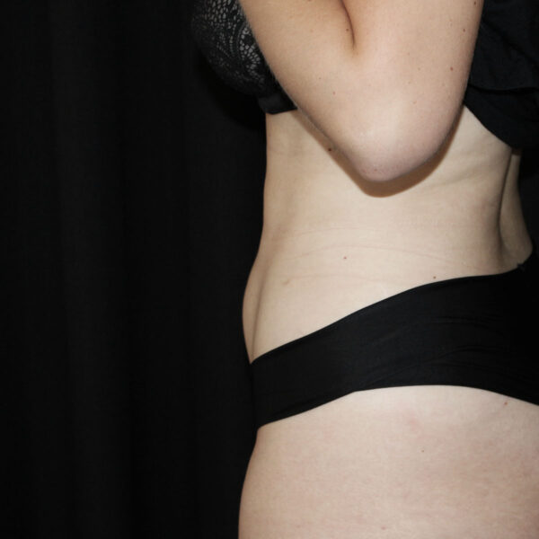 Fedtsugning - Efter