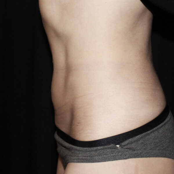 Fedtsugning - Efter