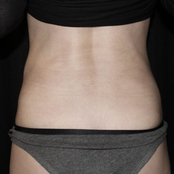 Fedtsugning - Efter