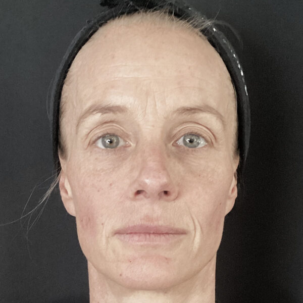 Filler, flere områder - Efter