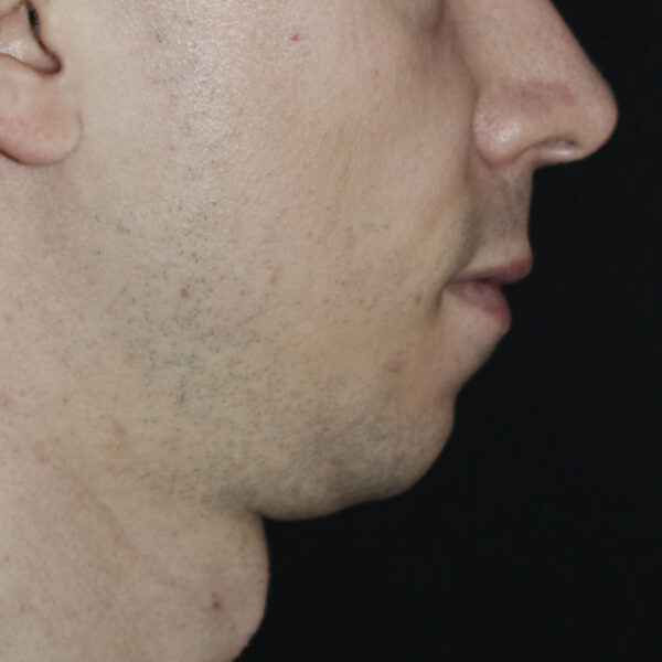 Filler - Før