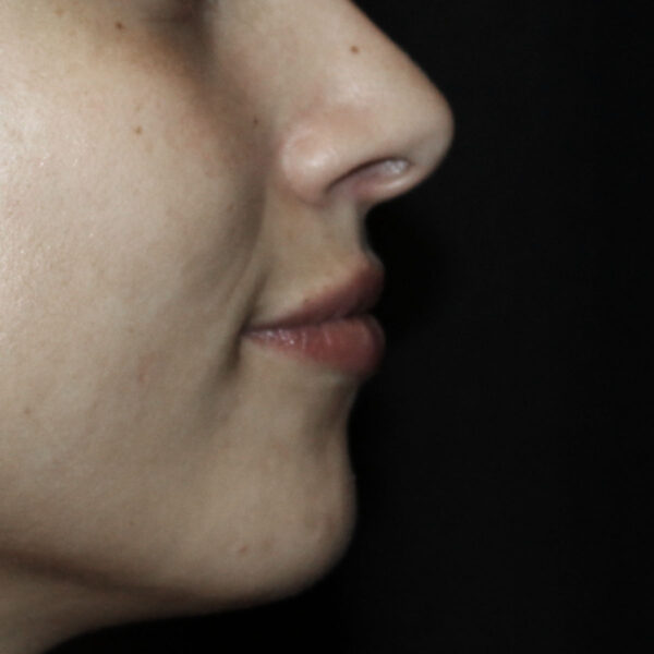 Filler - Efter